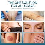 Scar Gel for Skin Care Fade Burn Scar Cream for Ladies Personal Care Product - Image 3